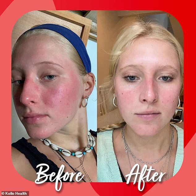 Amazing results: Users flocked to the Kollo Health website to share their impressive before and after photos of clear skin.