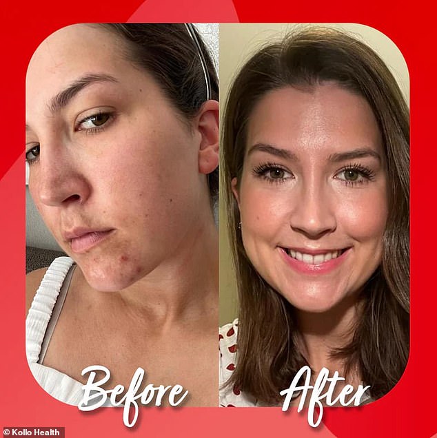 Visible difference: Using Kollo Health's liquid collagen, this user experienced clearer, brighter and more radiant skin.